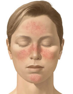 Acne Rosacea