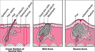 Causes of Acne