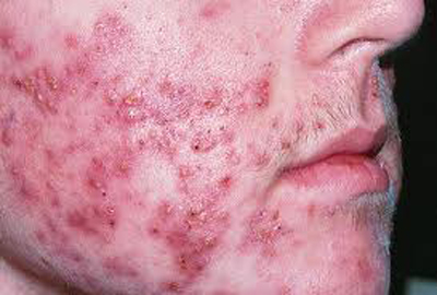 Severe Acne